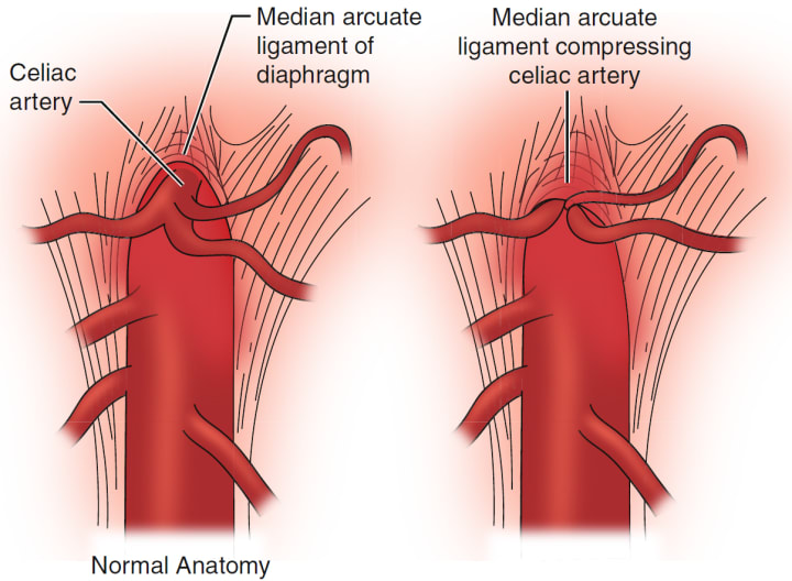 Image 2 Median Arcuate Ligament Anatomy